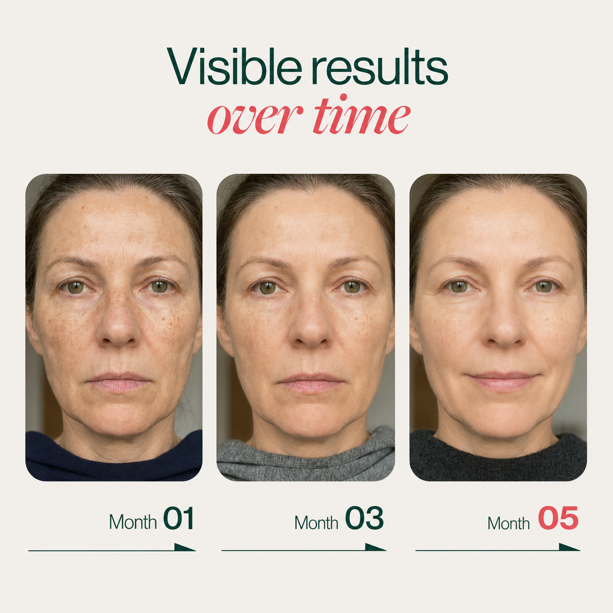 Visible results over time — Month 01, Month 03, Month 05 skin progression